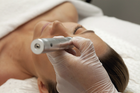 Microneedling: Dermapen anwendung bei einer Frau