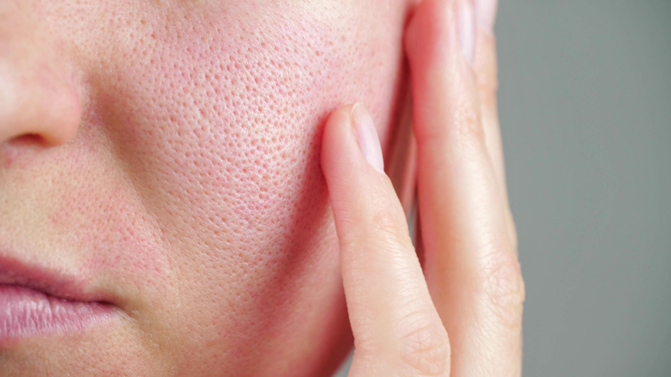 Mit Microneedling große Poren behandeln