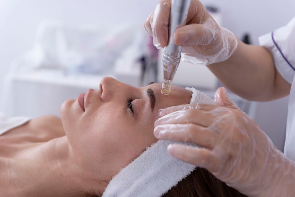 Microneedling wie oft?