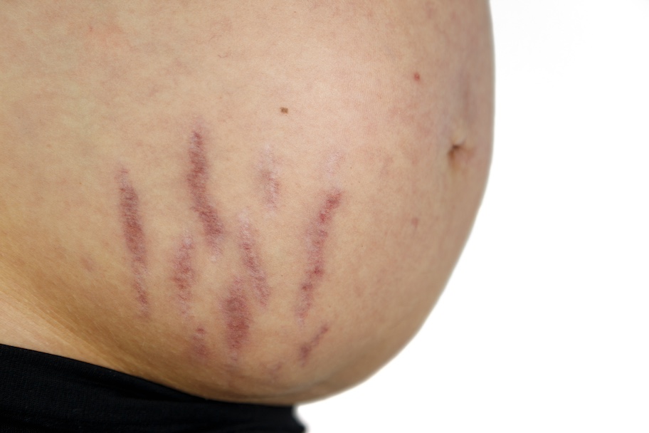 Microneedling gegen Dehnungsstreifen bzw. Schwangerschaftsstreifen