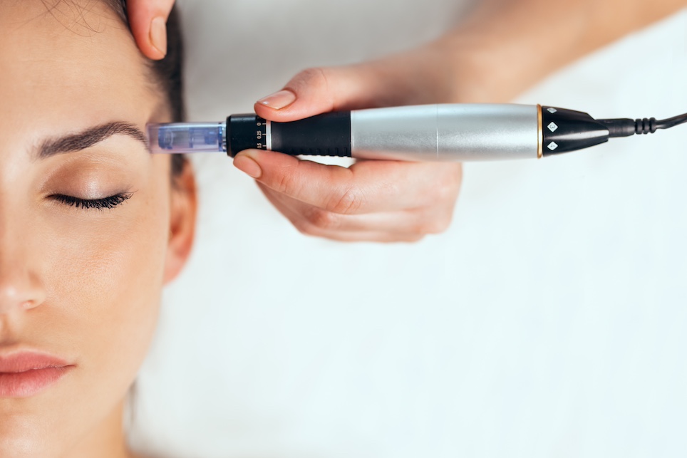 Microneedling-Behandlung mit einem Dermapen